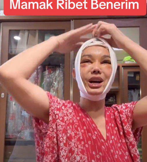 Bunda Corla operasi plastik (TikTok.com/fadiqmaksum)