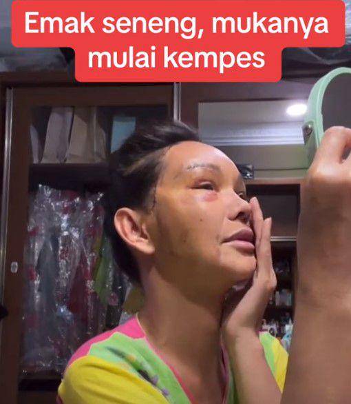 Bunda Corla operasi plastik (TikTok.com/fadiqmaksum)