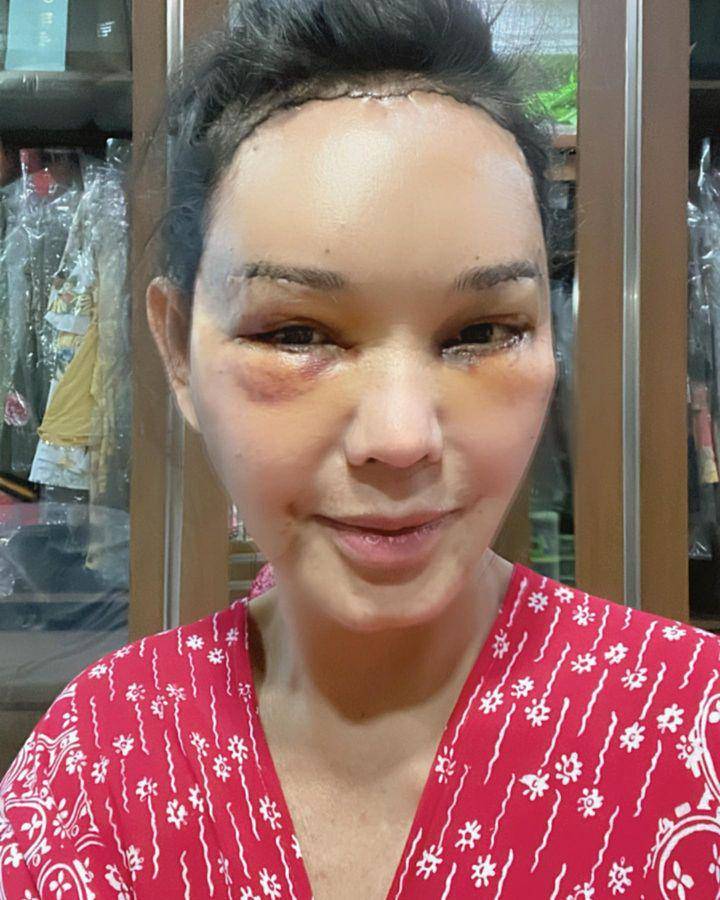 Bunda Corla operasi plastik (Instagram.com/corla_2)