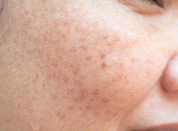 ilustrasi melasma (freepik.com/sri_sakorn42)