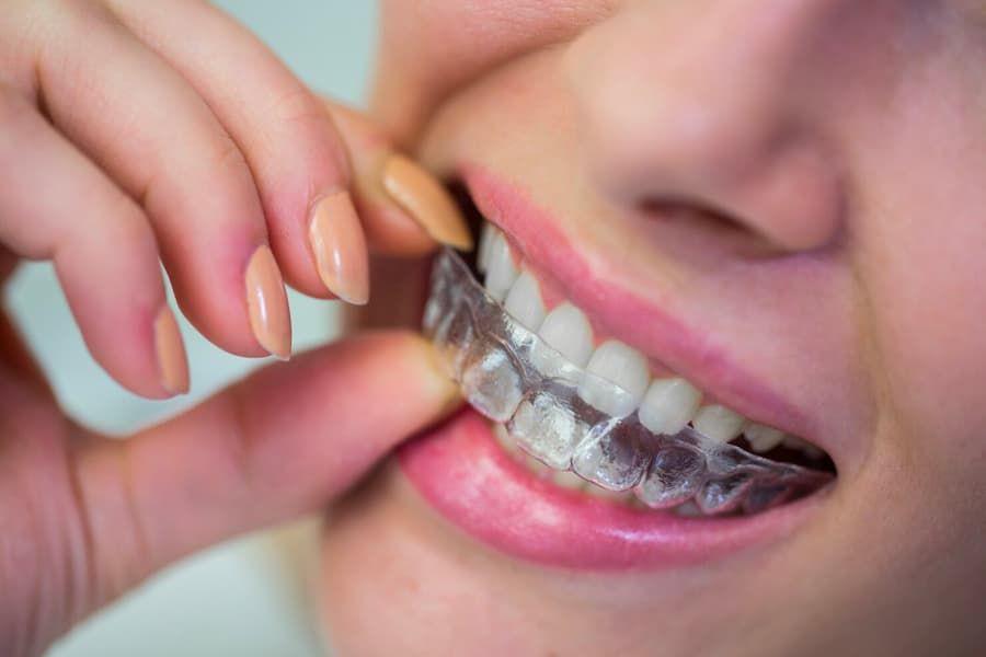 Perbedaan Retainer dan Aligner, Tujuan hingga Pemakaiannya