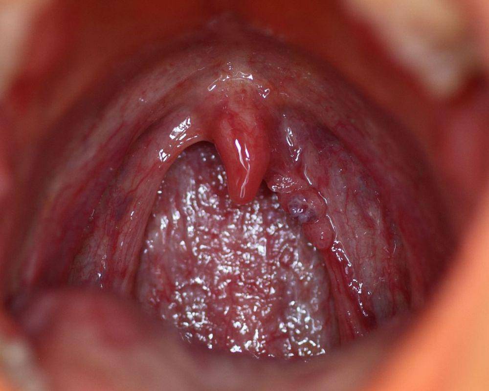 ilustrasi hpv di mulut (commons.wikimedia/gallias m)