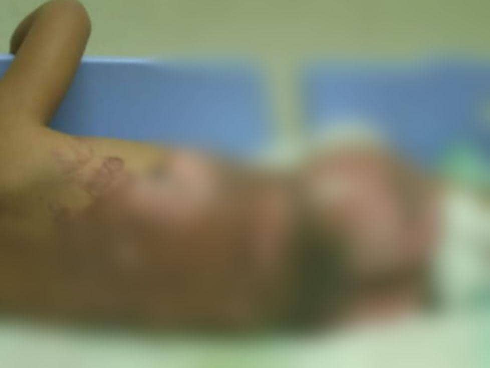 Balita Tercebur Sayur Panas Asal Ponorogo Akhirnya Meninggal
