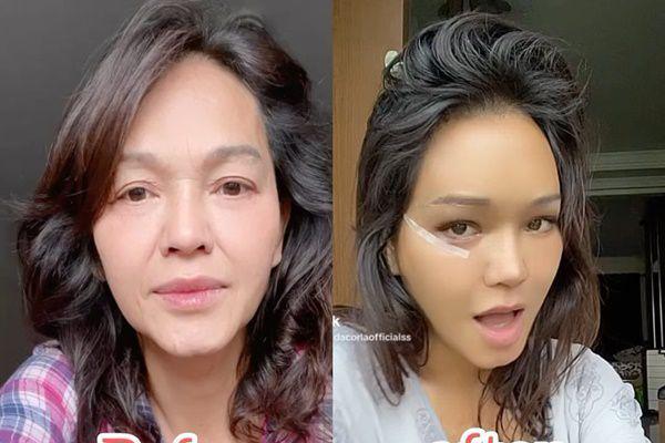 7 Potret Wajah Bunda Corla usai Lepas Perban Oplas, Bikin Pangling