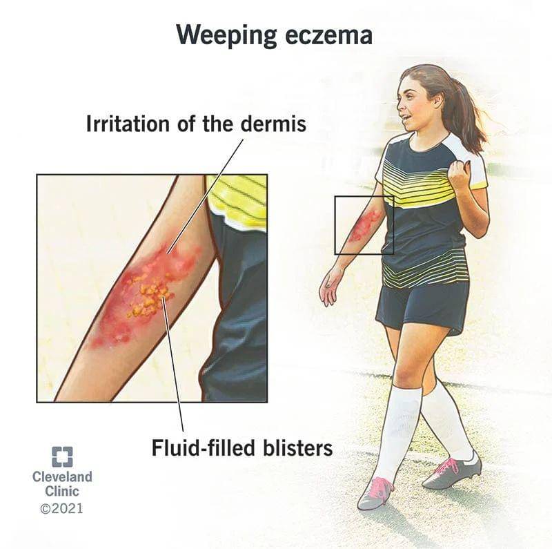 ilustrasi eksim basah atau weeping eczema (my.clevelandclinic.org)
