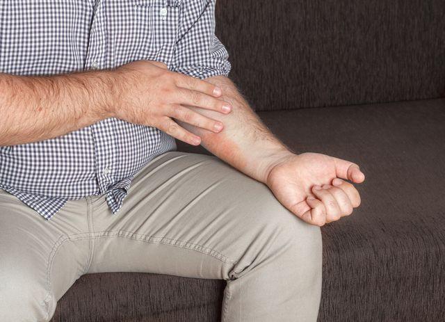 Eksim Basah: Gejala, Penyebab, Diagnosis, Pengobatan