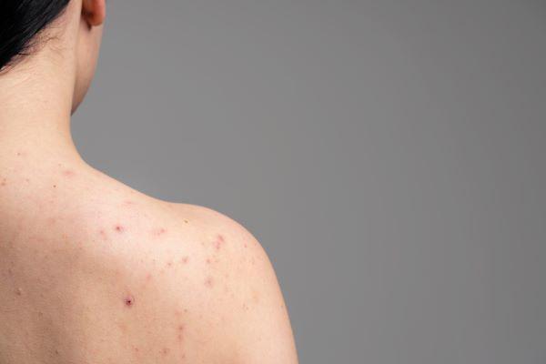 4 Tips Merawat Kulit Bekas Luka Mpox