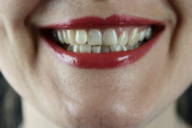 Kenali 5 Faktor Pemicu Fluorosis pada Gigi