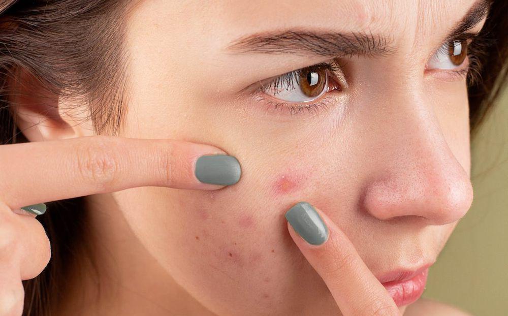 4 Rekomendasi Acne Patch Merek Lokal untuk Sembuhkan Jerawat