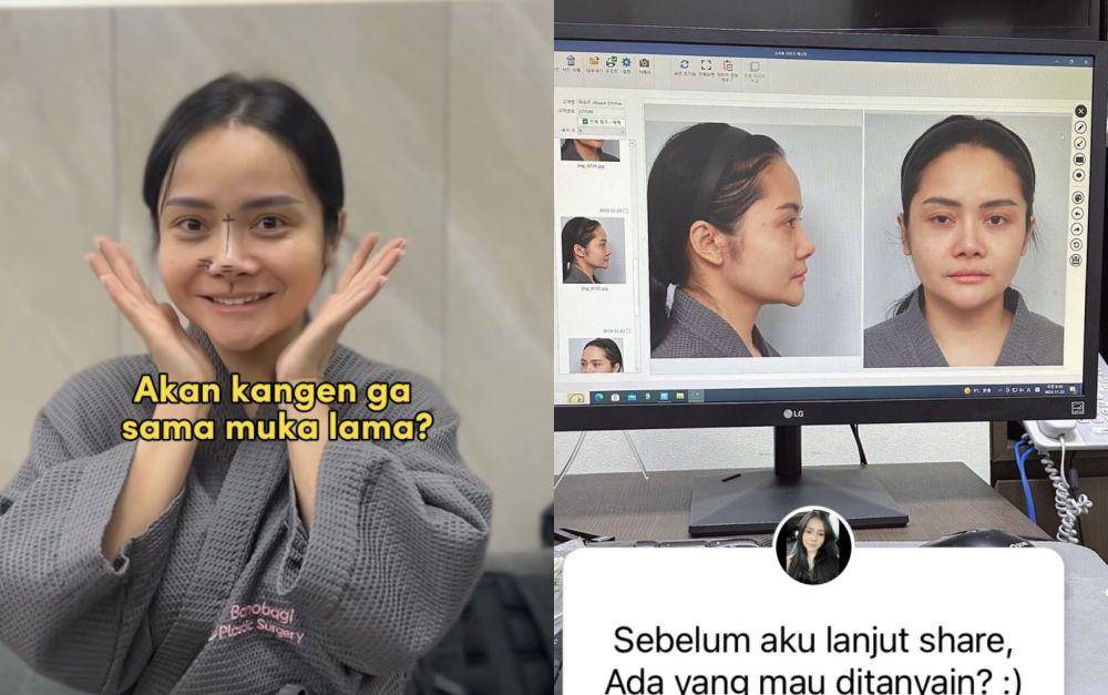 7 Potret Mawar AFI Operasi Plastik di Korea, Ini Penampilan Terkininya