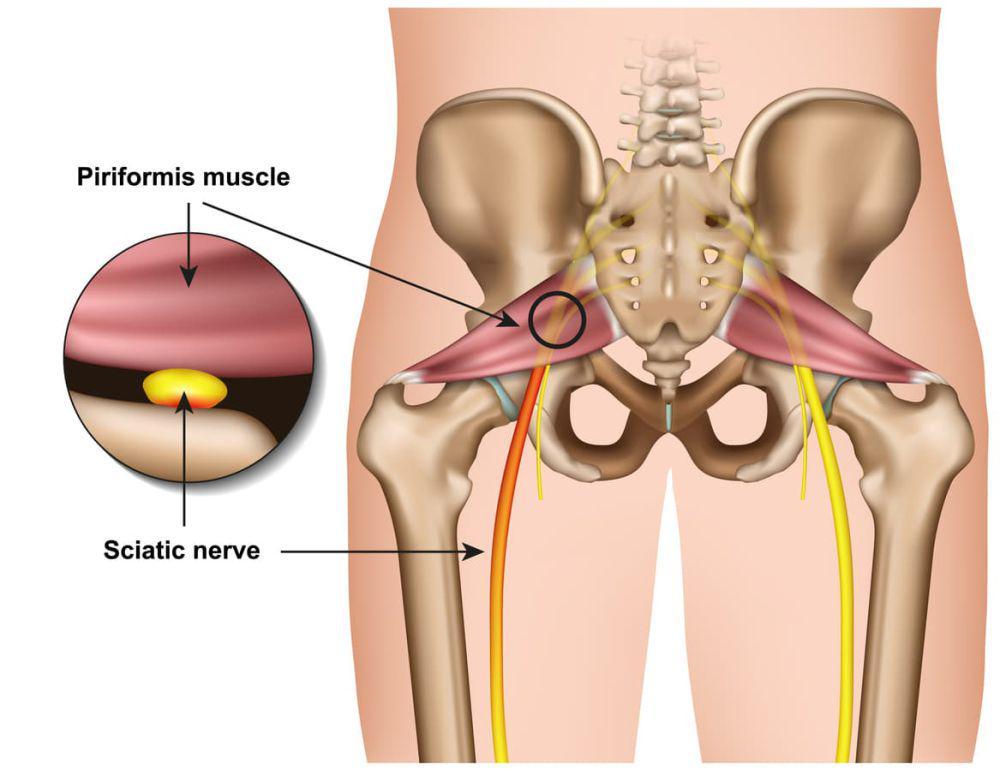 ilustrasi otot piriformis (healthcentral.com)