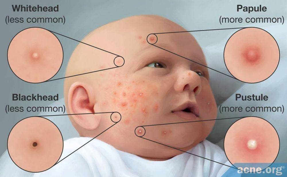 ilustrasi jerawat bayi (acne.org)