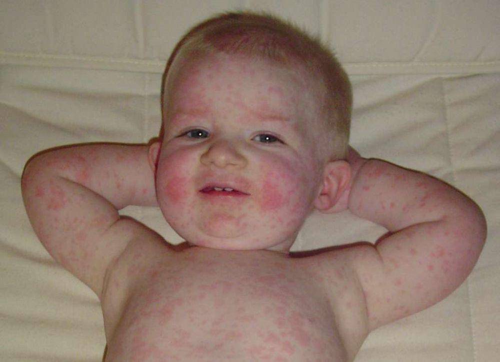 ilustrasi ruam pada kulit bayi akibat penyakit kelima atau erythema infectiosum (picryl.com/Wikimedia Commons)