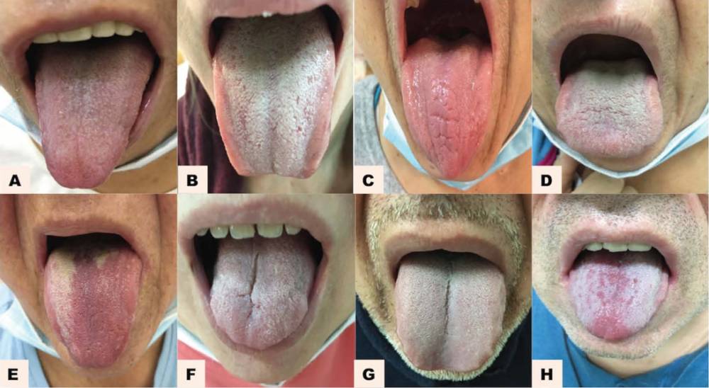 ilustrasi COVID-19 tongue (scielo.br/Pesquisa Brasileira em Odontopediatria e Clínica Integrada, 2021)