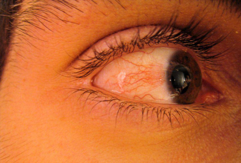 ilustrasi Ophthalmia nodosa, yaitu iritasi pada mata (flickr.com/Titanas)