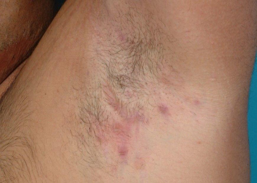 Hidradenitis suppurativa (Hurley's Staging II) di aksila kiri. (commons.wikimedia.org/BMC Dermatology/Ziyad Alharbi, Jens Kauczok, Norbert Pallua)