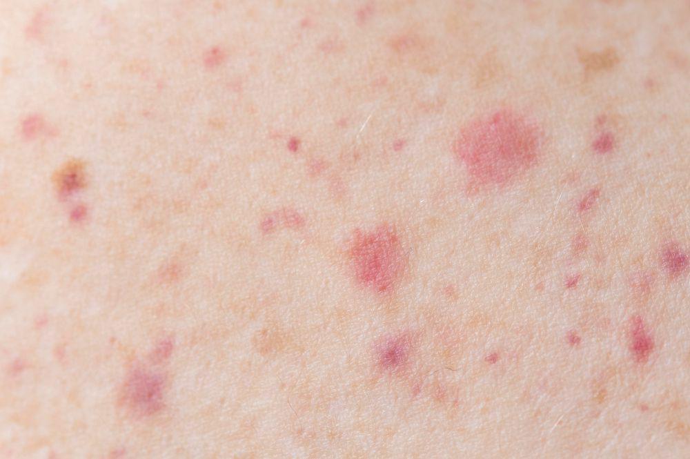 ilustrasi dermatitis (freepik.com/freepik)