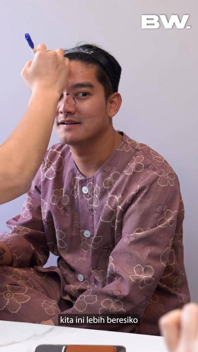 potret Boy William jalani Rhinoplasty (instagram.com/boywilliam17)
