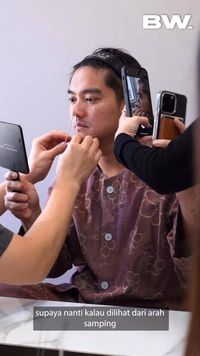 potret Boy William jalani Rhinoplasty (instagram.com/boywilliam17)