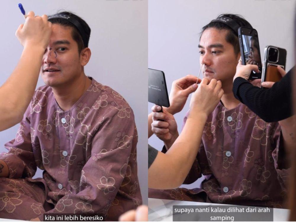 8 Potret Boy William Jalani Prosedur Rhinoplasty, Demi Kesehatan