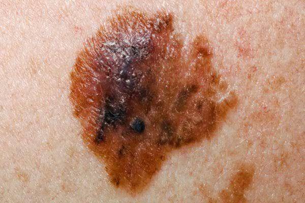 ilustrasi tanda kanker melanoma (nhs.uk)