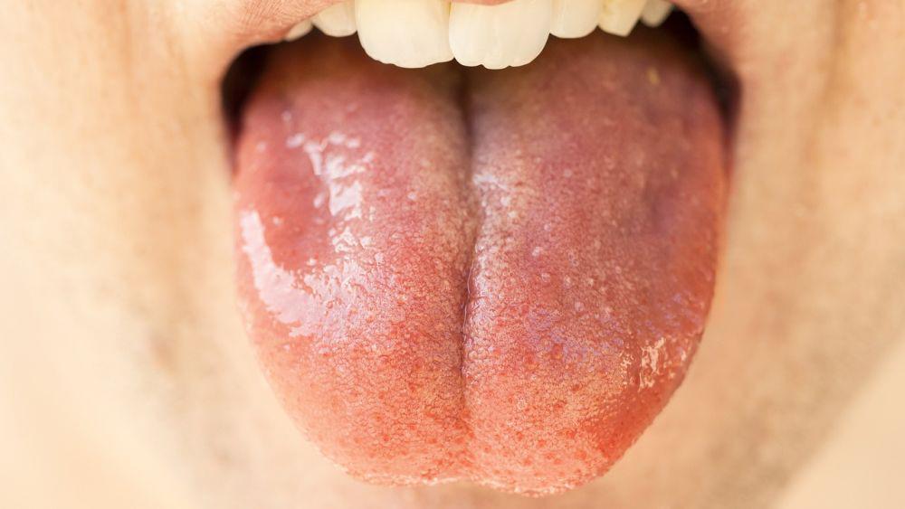11 Cara Mengatasi Air Liur Berlebihan