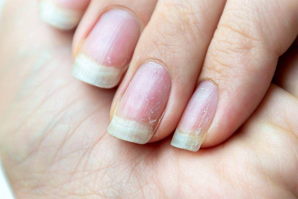 Ilustrasi kuku rapuh (www.nailboo.com)