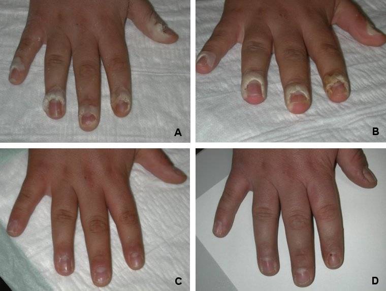 Pemulihan kutil periungual pada pasien laki-laki usia 18 tahun. (commons.wikimedia.org/Department of Dermatology and Allergology, Friedrich Schiller University Hospital, Jena, Germany)