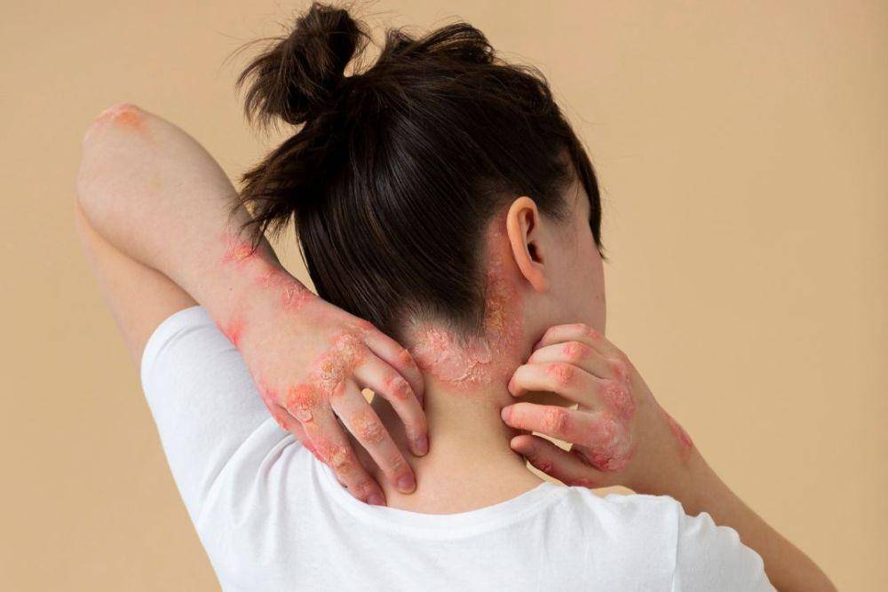 ilustrasi psoriasis kulit kepala (freepik.com/freepik)
