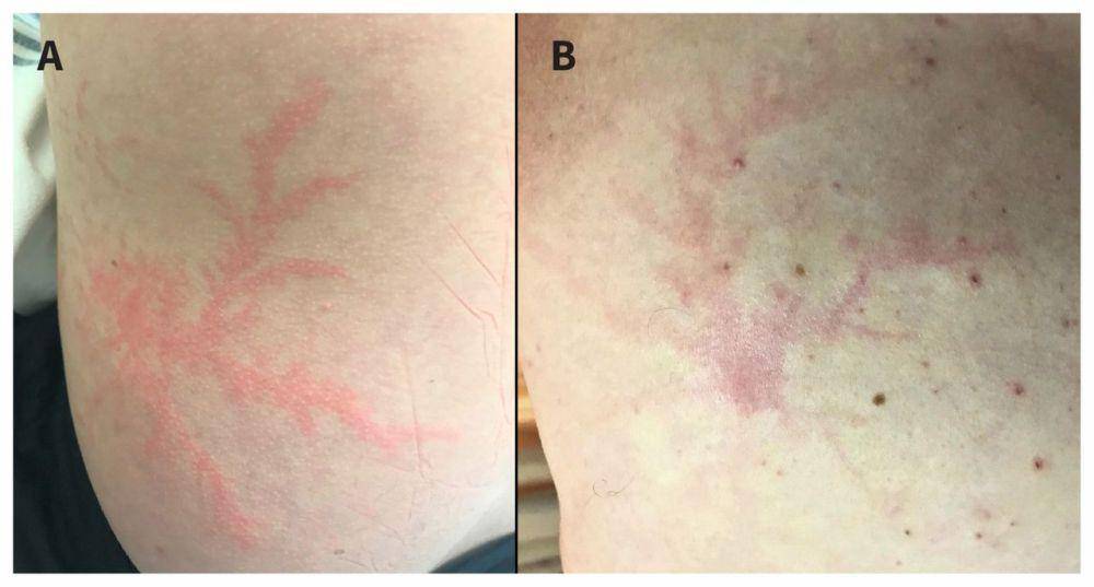 Luka Lichtenberg atau Lichtenberg figures pada korban sambaran petir. (cmaj.ca/CMAJ March 04, 2019 191 (9) E260)