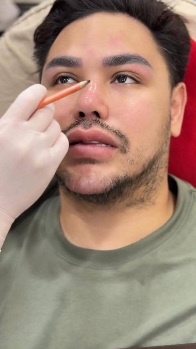 potret Ivan Gunawan jalani treatment tarik benang (instagram.com/ivan_gunawan)