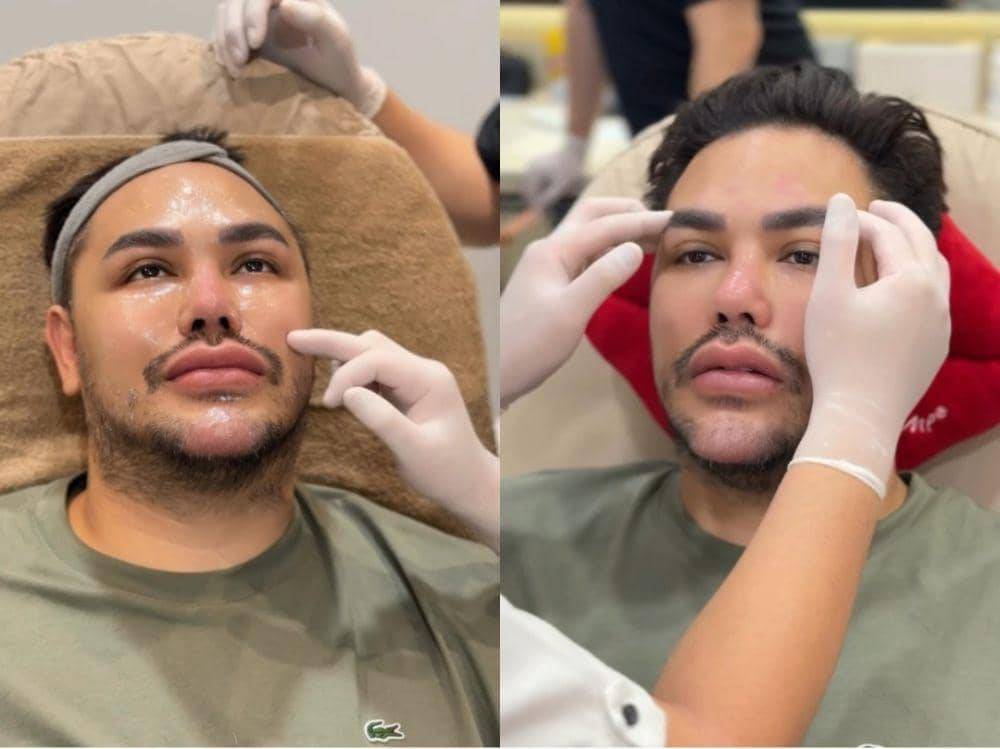 8 Potret Ivan Gunawan Jalani Prosedur Tarik Benang, Akui Kena Mental