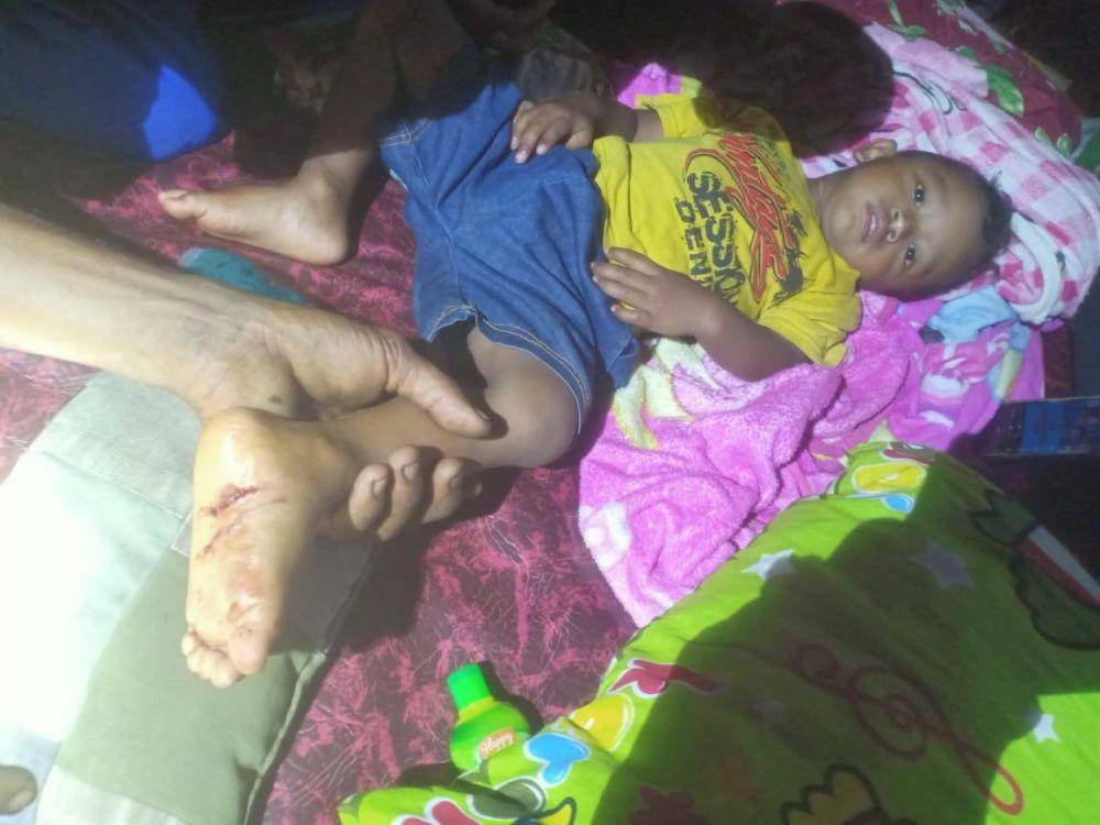 Telapak kaki balita yang digigit Harimau Sumatra di Kabupaten Siak (IDN Times/ Fanny Rizano)