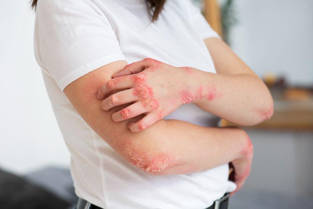 Studi: Pasien Psoriasis Lebih Mungkin Mengembangkan Masalah Jantung