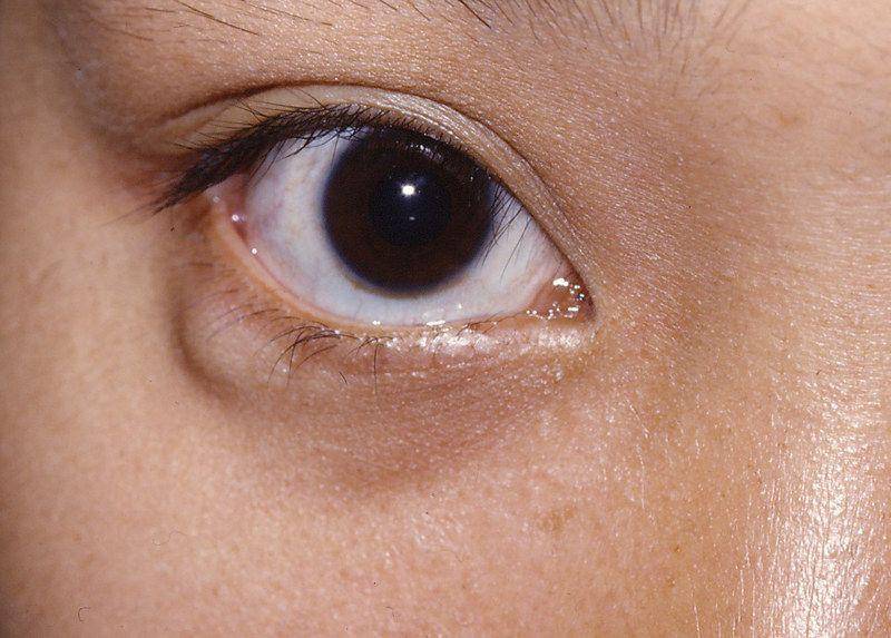 ilustrasi kalazion (flickr.com/Community Eye Health)