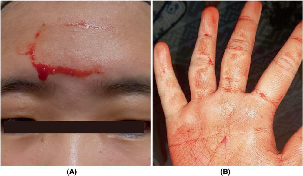 Hematohidrosis, Fenomena Langka Berkeringat Darah