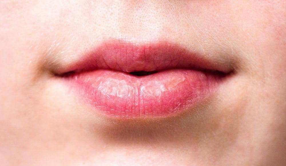 ilustrasi bibir kering (pexels.com/Anemone123)