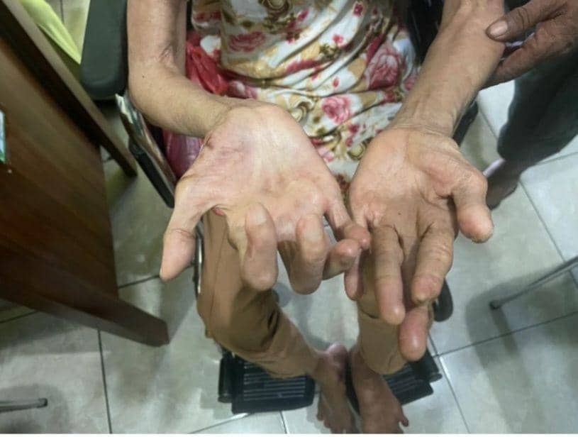 Ilustrasi pasien kusta (Dok.IDNTimes/Istimewa)