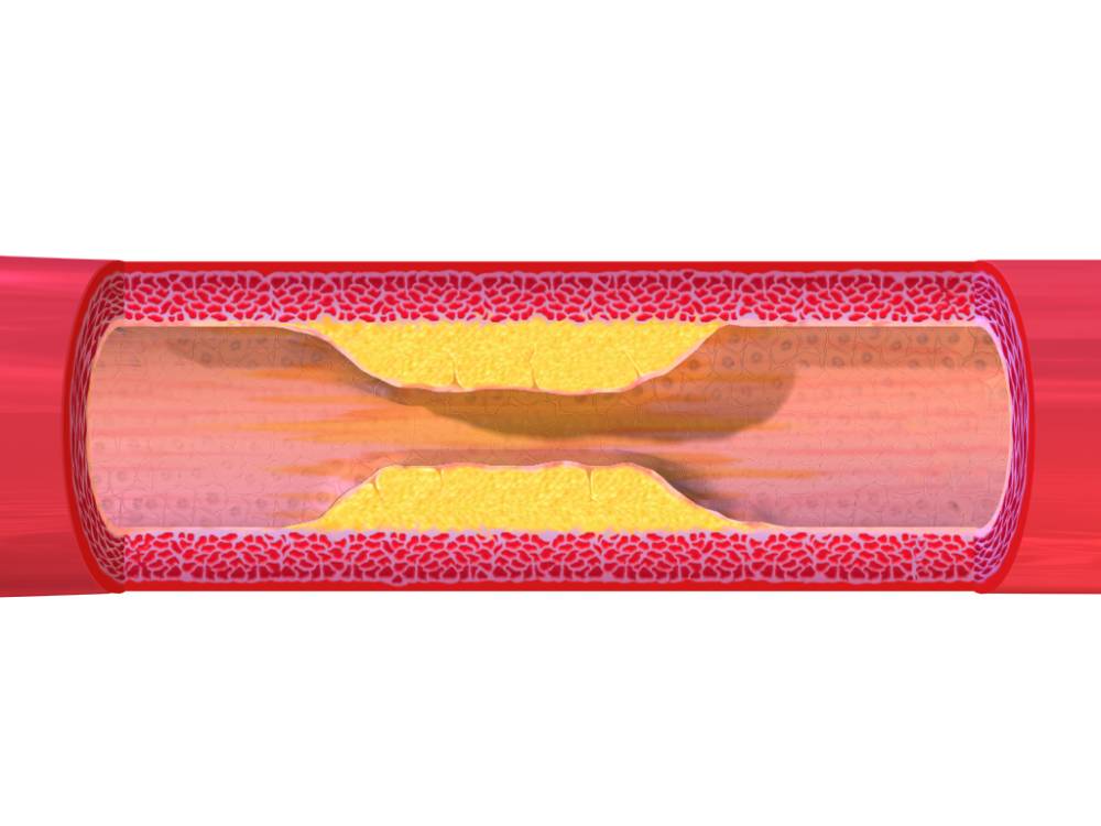 ilustrasi plak dalam pembuluh darah arteri (commons.wikimedia.org/BruceBlaus)