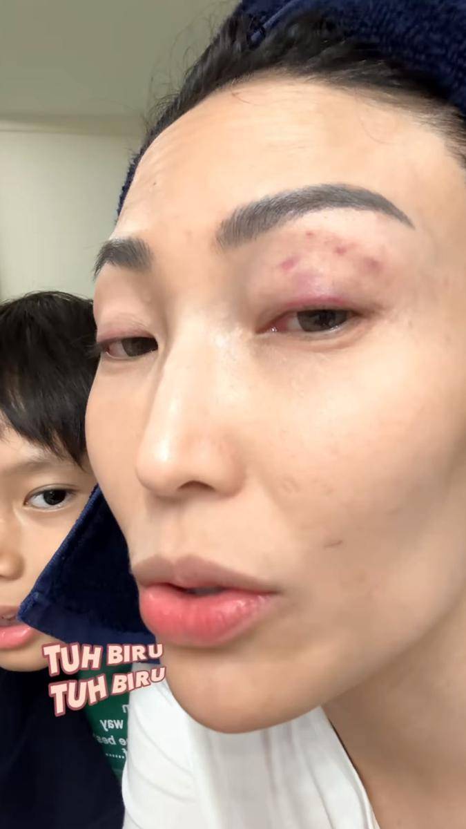 potret mata Ayu Dewi terkena pantulan bola tenis suaminya (instagram.com/mrsayudewi)