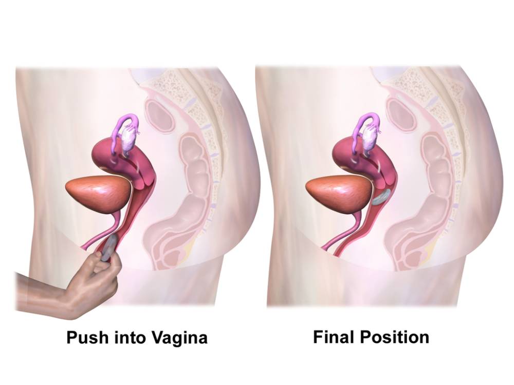 ilustrasi pemasangan kontrasepsi cincin vagina atau vaginal ring (commons.wikimedia.org/BruceBlaus)