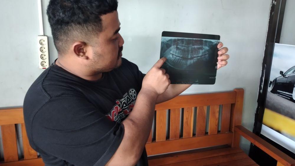 Cerita Wanita Ngawi Meninggal Dunia Usai Cabut Gigi Bungsu