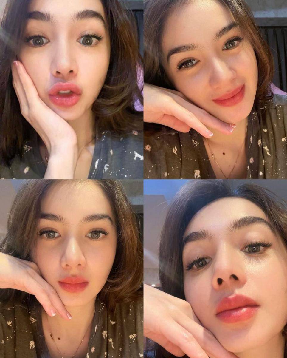 potret Angel Karamoy usai oplas (instagram.com/realangelkaramoy)
