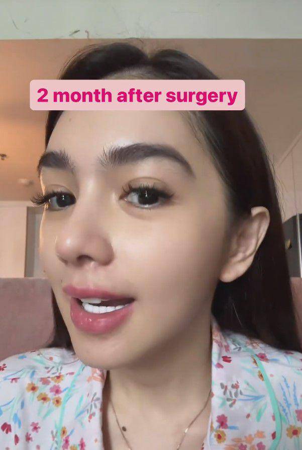 potret Angel Karamoy usai oplas (instagram.com/realangelkaramoy)