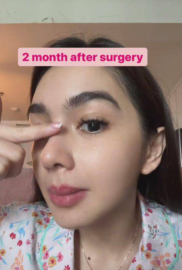 potret Angel Karamoy usai oplas (instagram.com/realangelkaramoy)