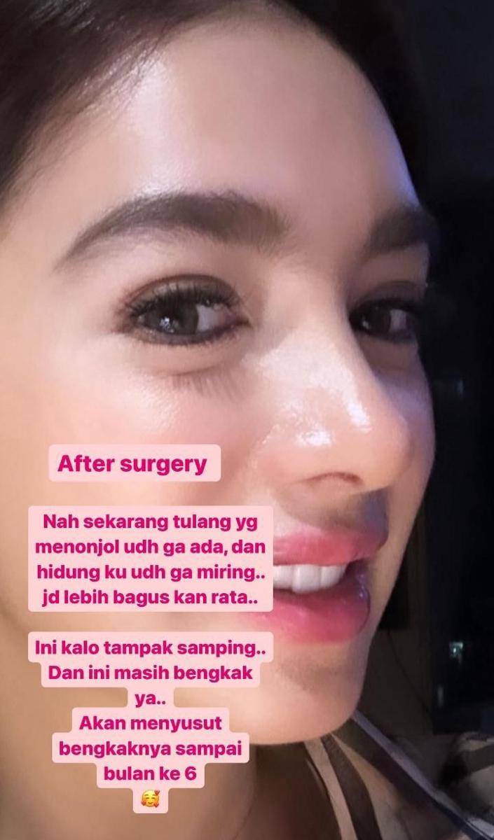 potret Angel Karamoy usai oplas (instagram.com/realangelkaramoy)