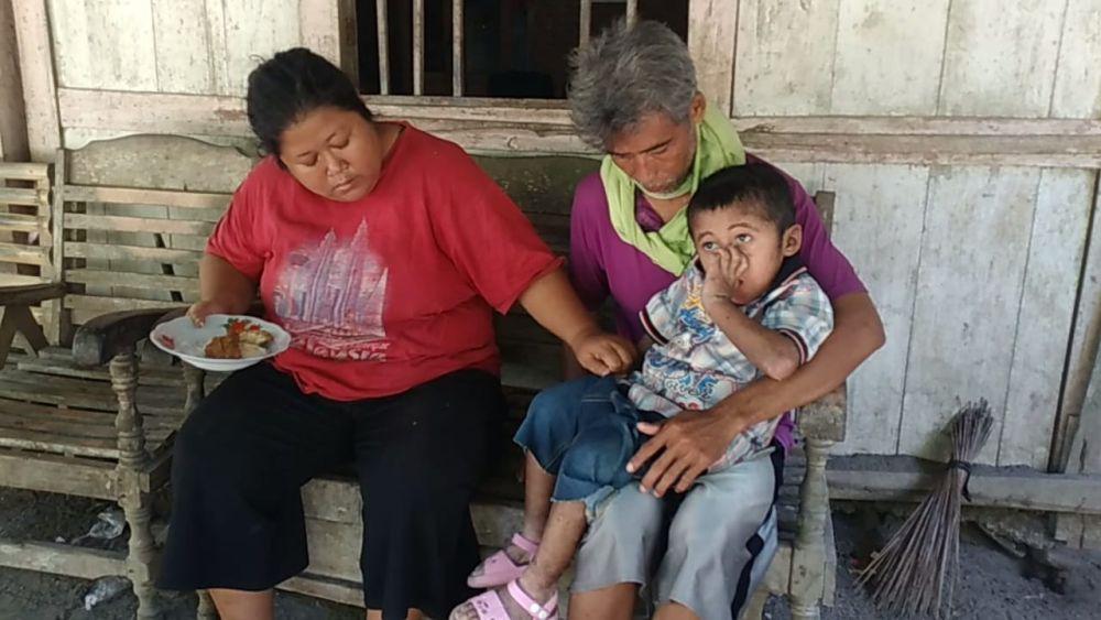 Balita 3 Tahun di Madiun Mengidap Penyakit Kulit Langka