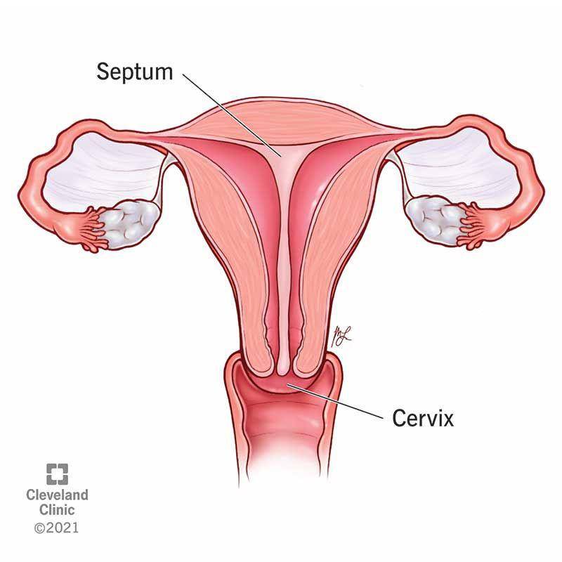 Rahim bersepta (clevelandclinic.org)