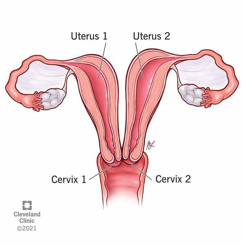 Rahim didelphic (clevelandclinic.org)