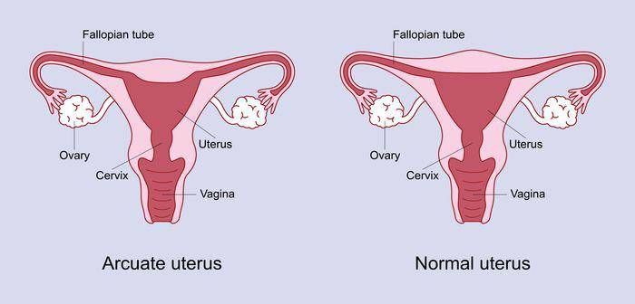 Rahim arcuate (pregnancybirthbaby.org.au)